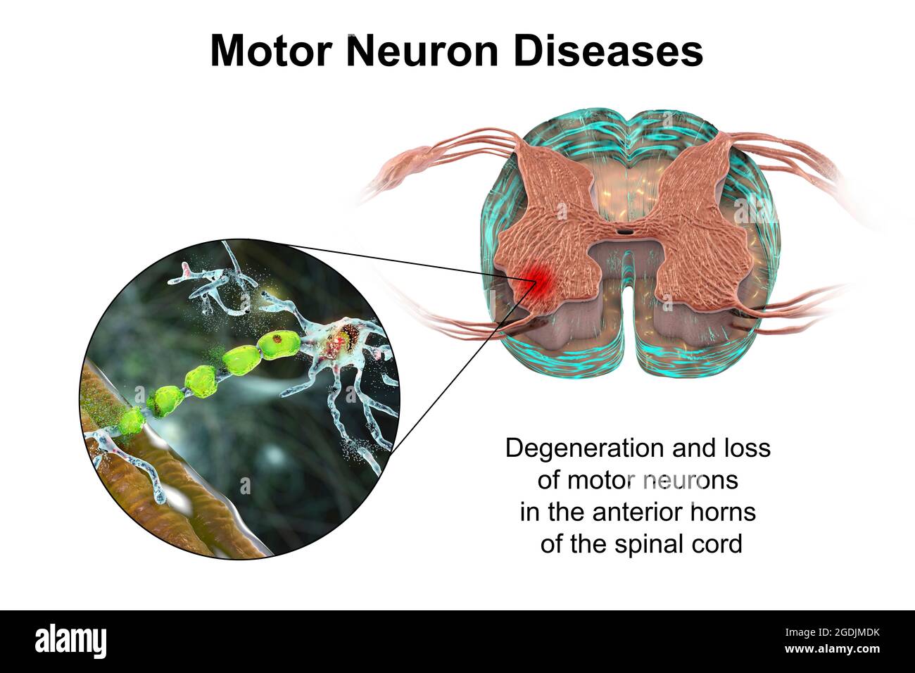 Enfermedades de las neuronas motoras, ilustración Foto de stock