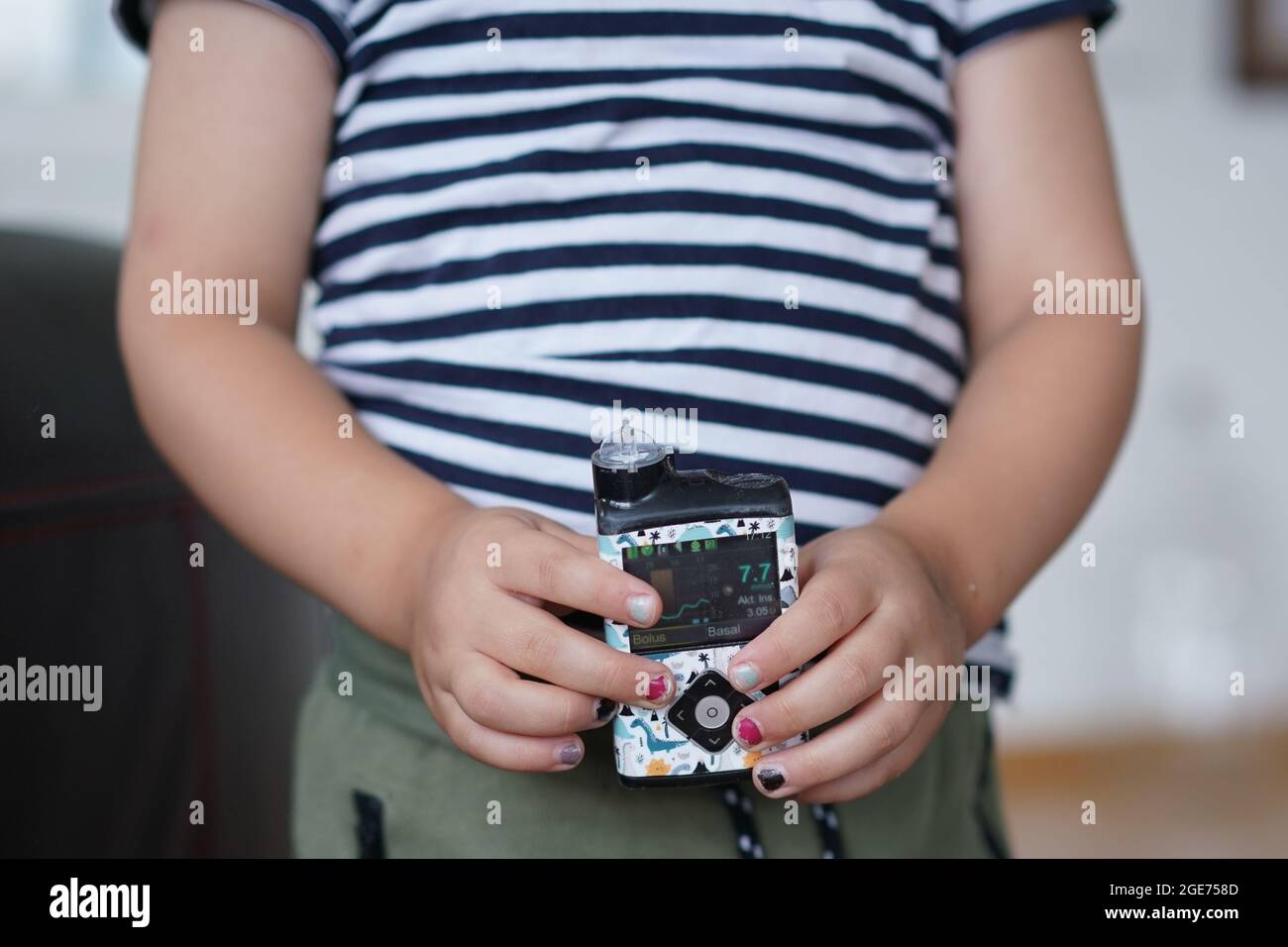 Berlín, Alemania. 03rd de agosto de 2021. Oskar, de cuatro años, tiene una bomba de insulina en sus manos. En Alemania, cada vez más niños y adolescentes están desarrollando diabetes mellitus tipo 1. Muchas personas no se dan cuenta de que incluso niños y adolescentes completamente sanos, deportivos y activos pueden desarrollar diabetes. (A dpa 'De repente diabético: Puede afectar incluso al más joven') Crédito: Jörg Carstensen/dpa/Alamy Live News Foto de stock