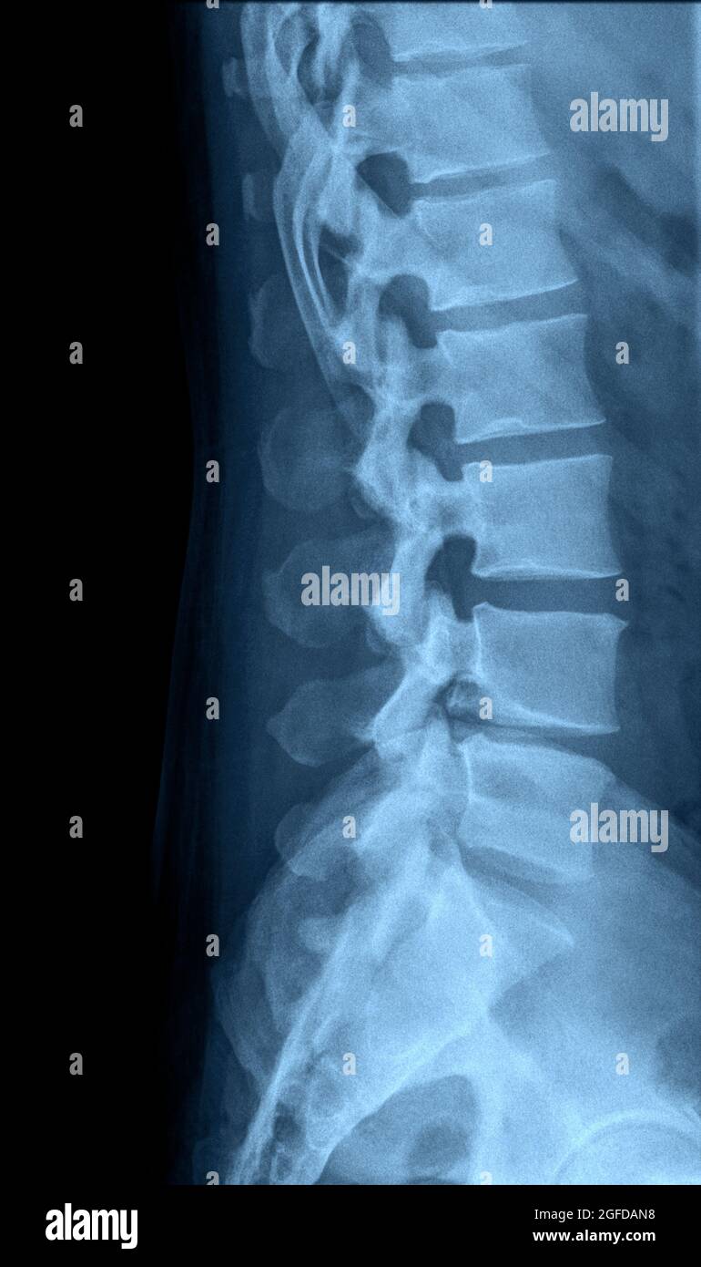 Vista lateral de rayos X de columna lumbar humana Fotografía de stock -  Alamy