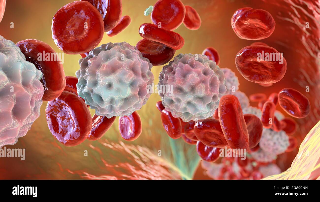 Ilustración de la linfocitosis, mostrando abundantes glóbulos blancos dentro de los vasos sanguíneos. Foto de stock
