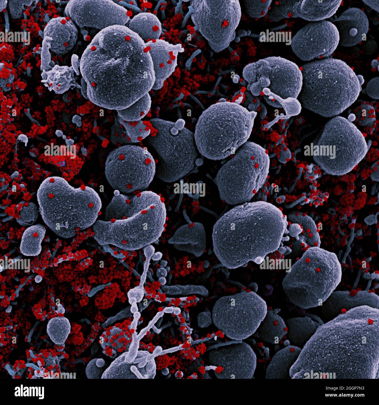 Micrografía electrónica coloreada de una célula apoptótica (gris) muy infectada con partículas del virus SARS-CoV-2 (rojo), aislada de una muestra de paciente. Foto de stock