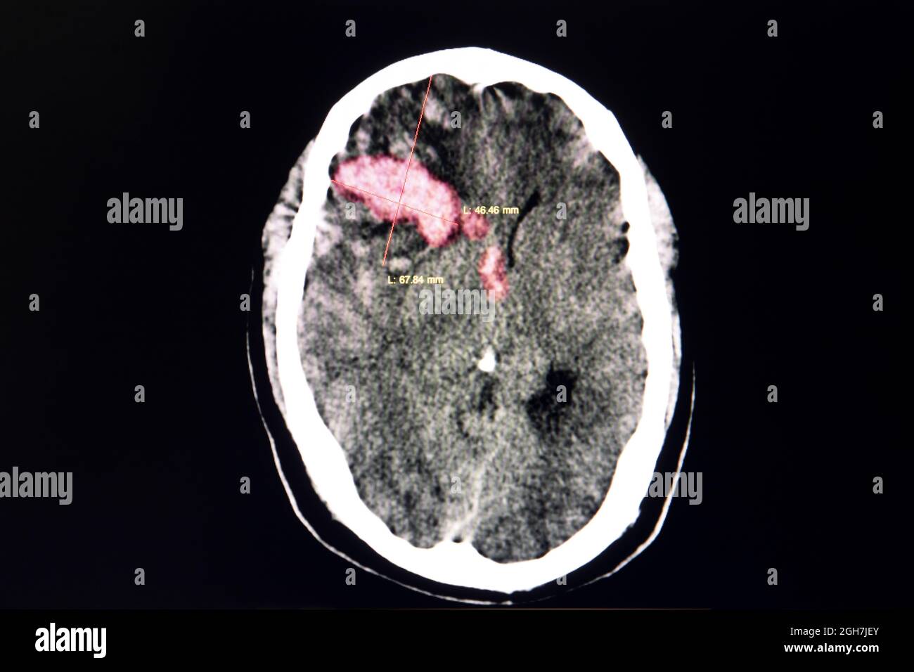 Hemorragia Cerebral Cerebro Fotograf As E Im Genes De Alta Resoluci N ...