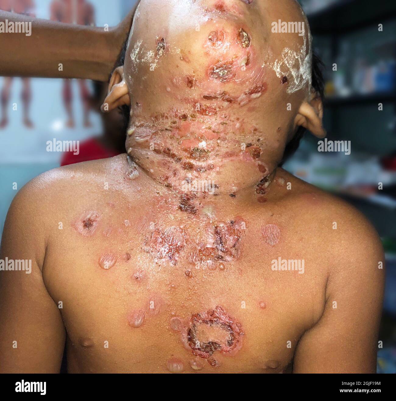 Múltiples impétigo o numerosas infecciones estafilocócicas o estreptocócicas de la piel en el pecho y el cuello del niño birmano del sudeste asiático en la clínica de Myanmar Foto de stock