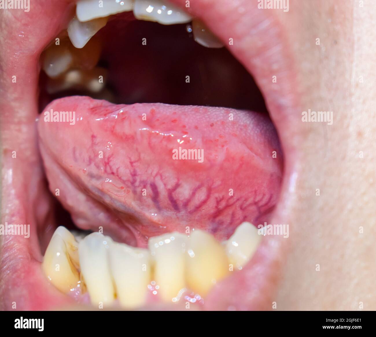 Venas prominentes, dilatadas y tortuosas llamadas varices en el lado lateral de la lengua. Vista de primer plano. Foto de stock