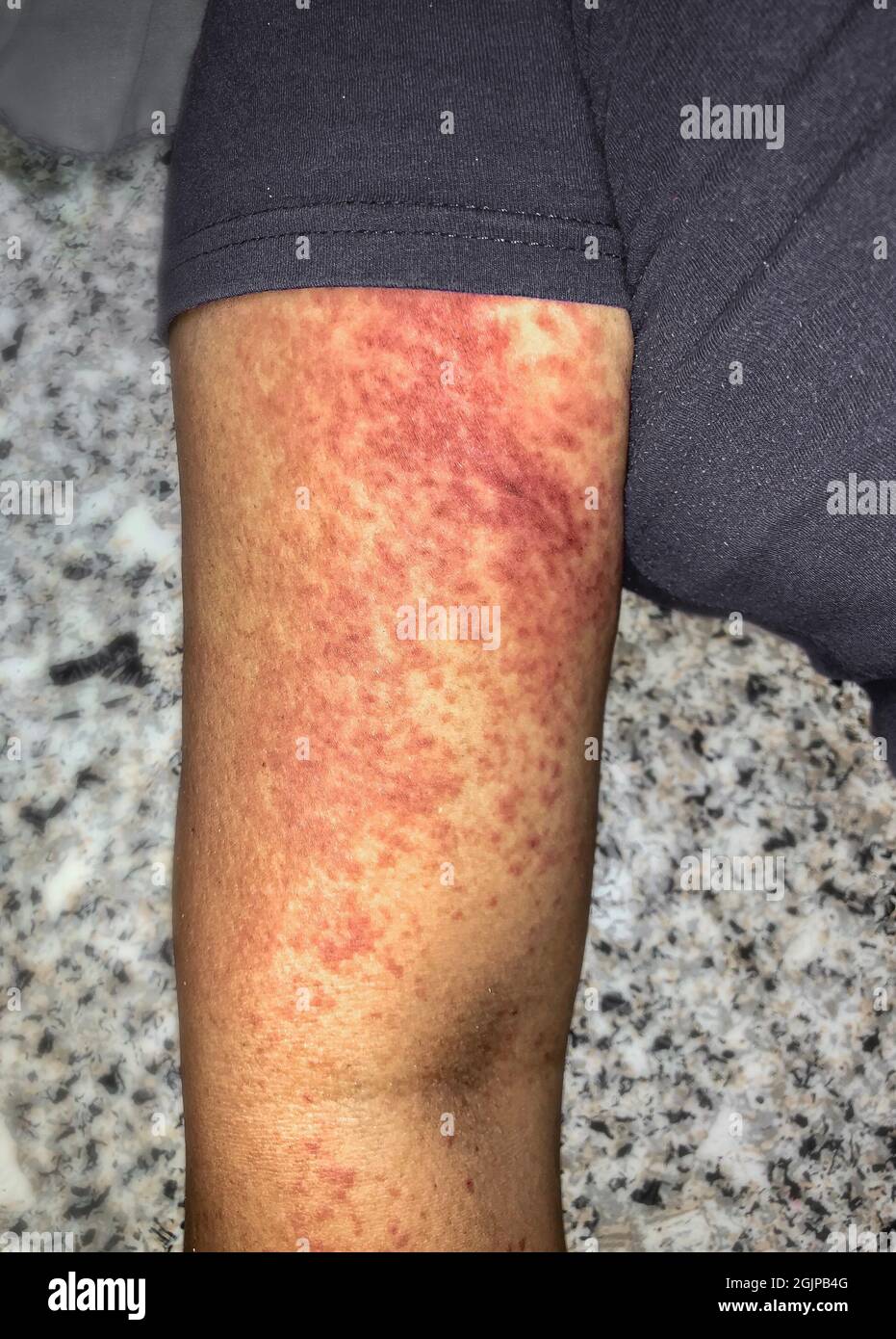 Fiebre del dengue hemorrágico fotografías e imágenes de alta resolución -  Alamy