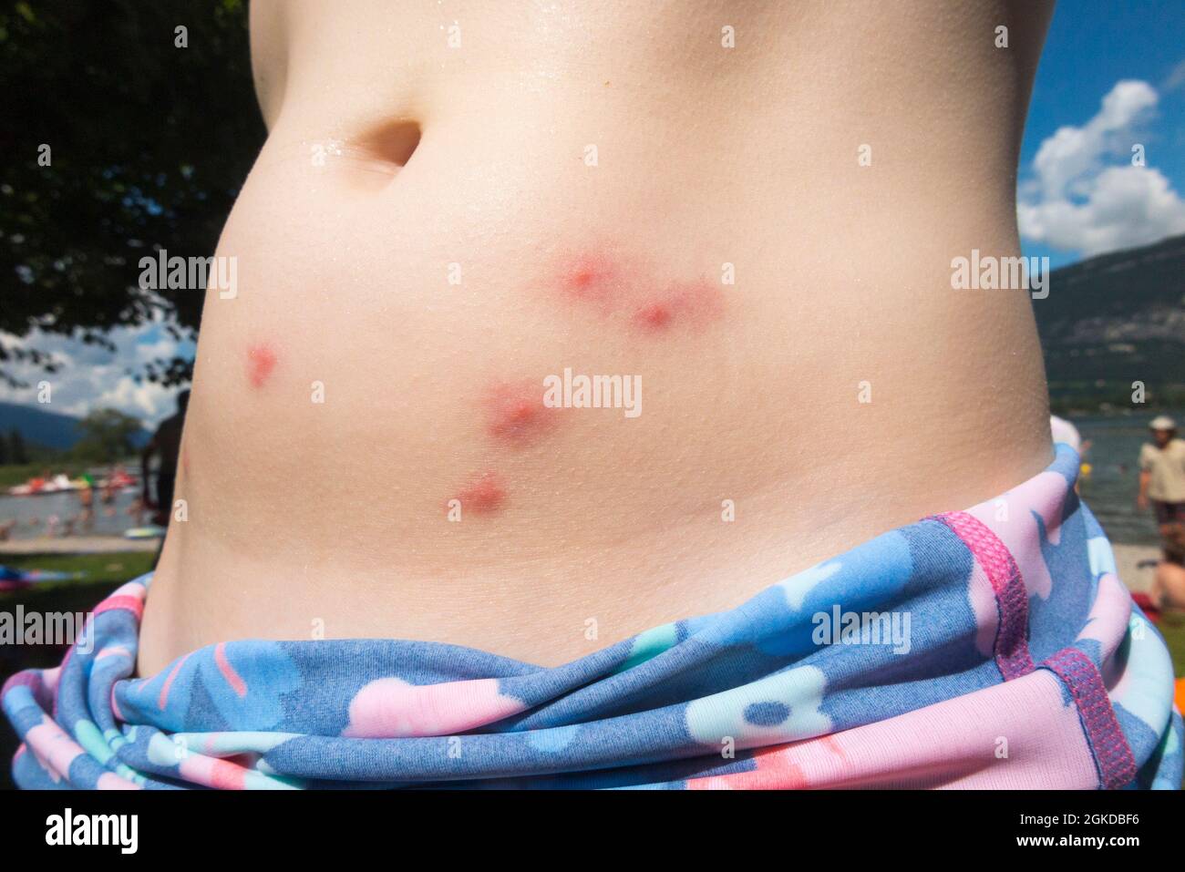 Niño turista niño niño niños de la piel del estómago, en Lac Du Bourget Francia con la inflamación pensó causado por pulgas de pato / parásitos Francés: puces de canard. (127) Foto de stock