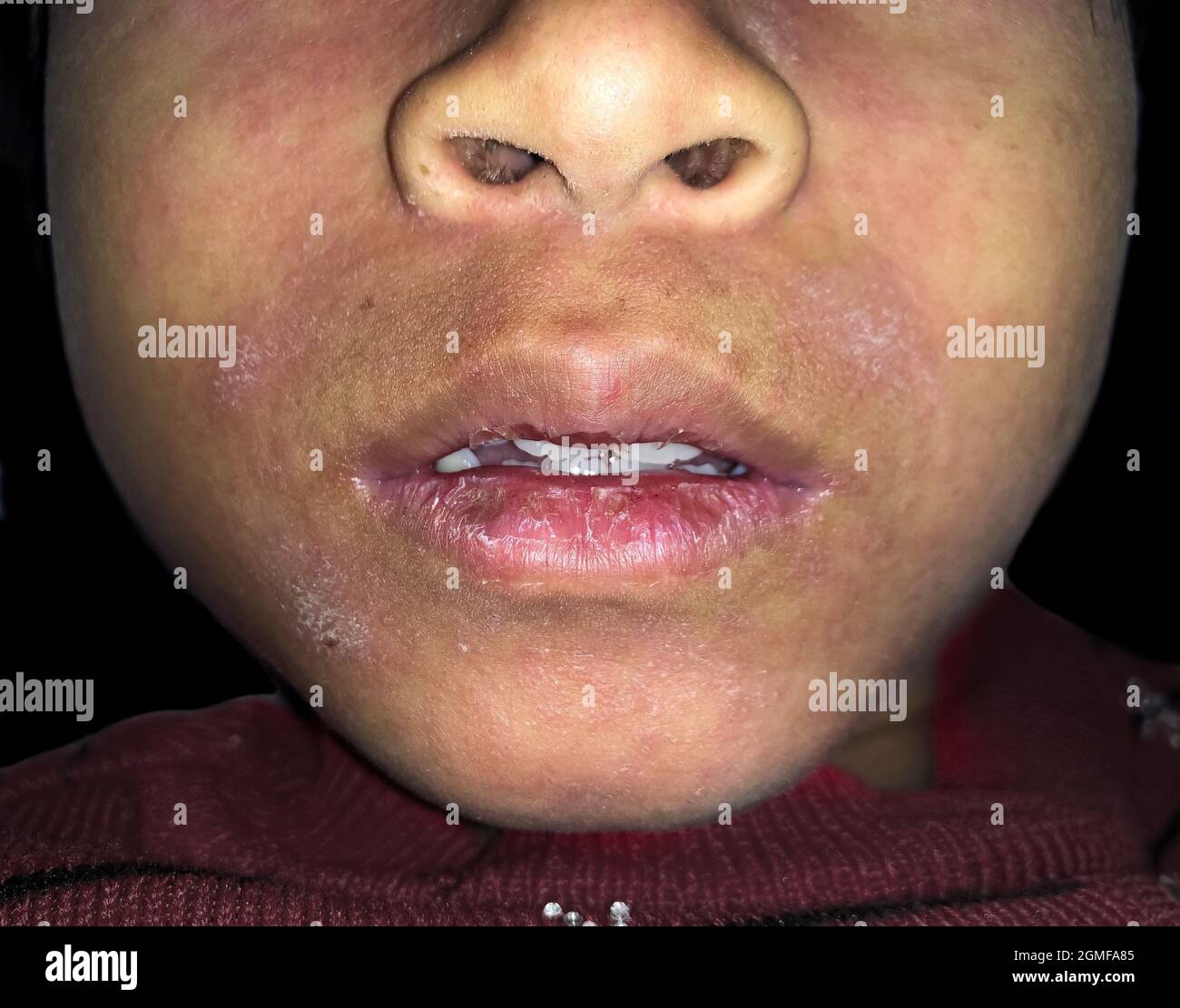 Perleche Fotos E Imagenes De Stock Alamy