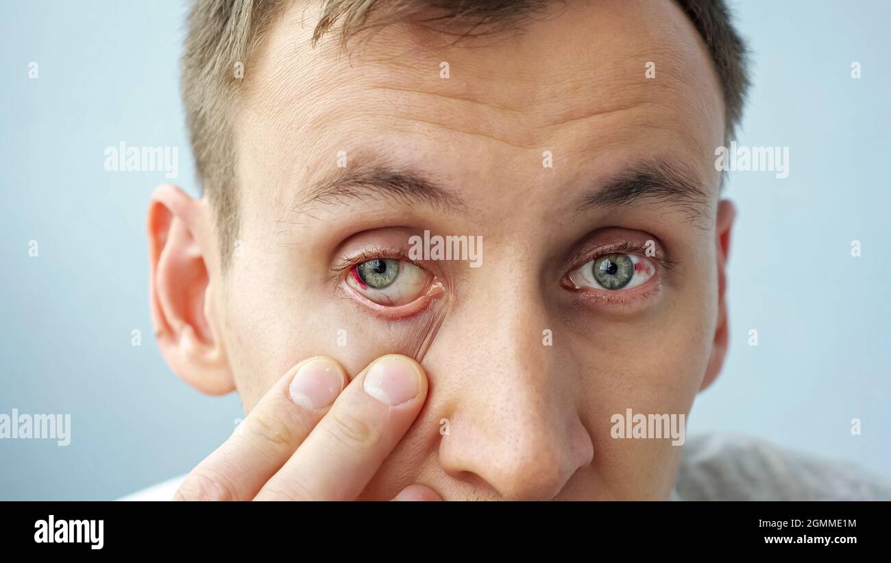 hombre con ojos rojos levantando los párpados con los dedos mirando la  cámara Fotografía de stock - Alamy