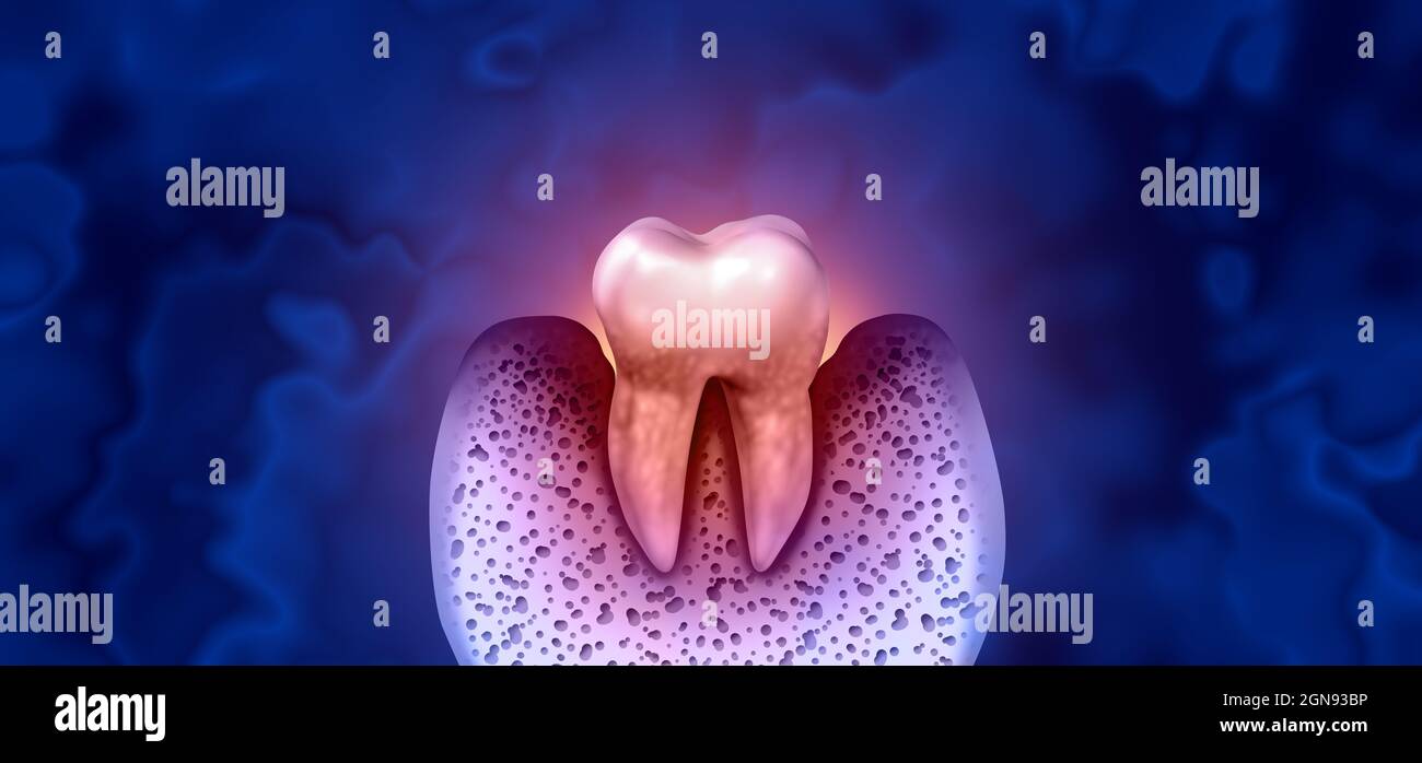 La enfermedad de caries dental como un molar malsano con periodontitis debido a un problema de salud de higiene oral pobre como concepto de infección bacteriana. Foto de stock