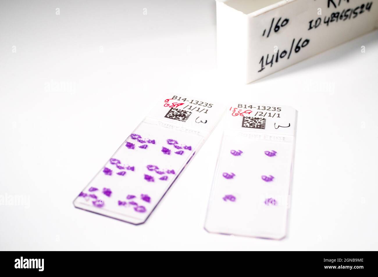 Biopsia gastrointestinal diapositivas. Diapositivas preparadas con muestras tomadas de tejidos teñidos de una mujer en el tracto gastrointestinal. Estas diapositivas se examinarán Foto de stock