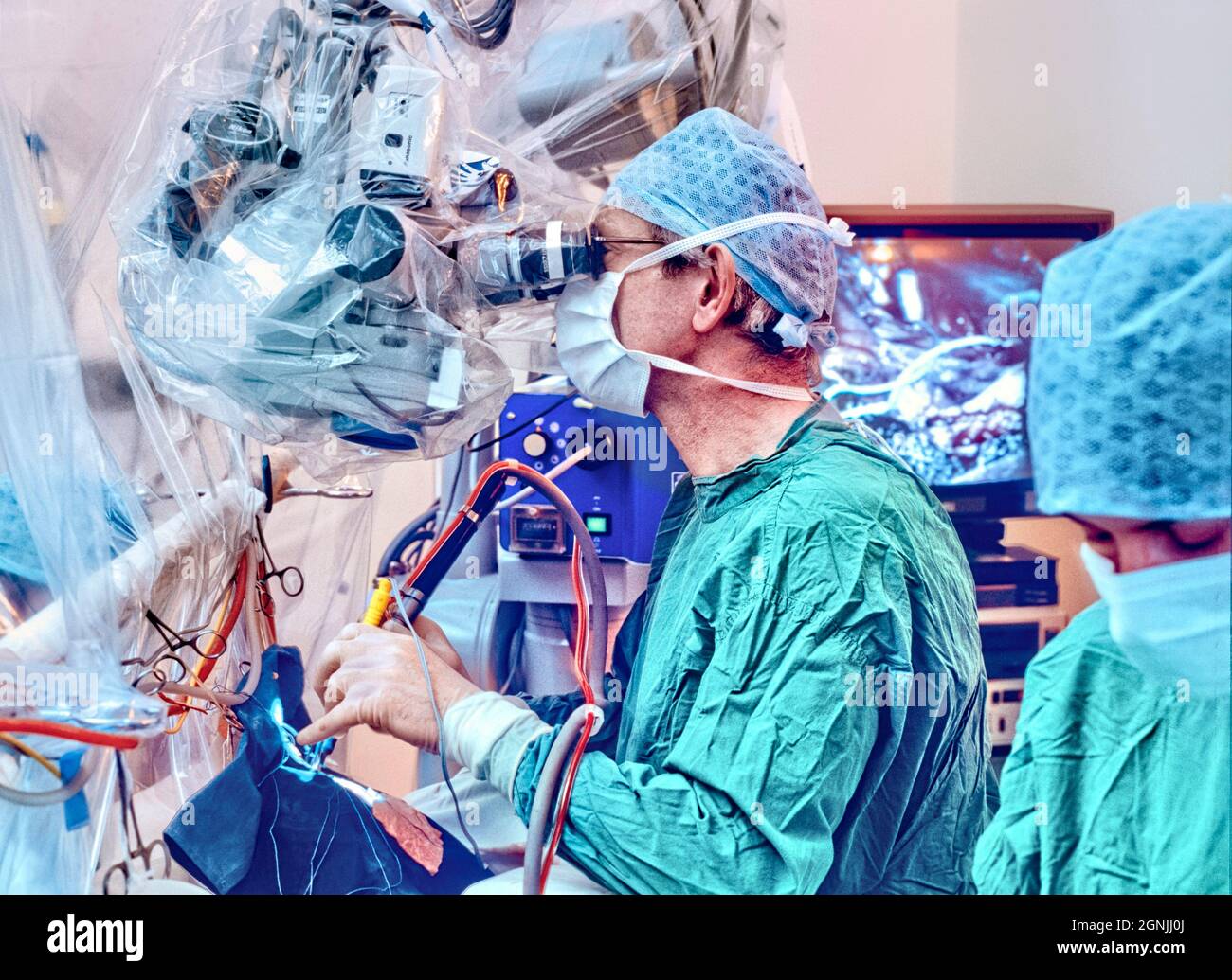 El neurocirujano realiza una microcirugía para la extirpación del tumor cerebral. Foto de stock