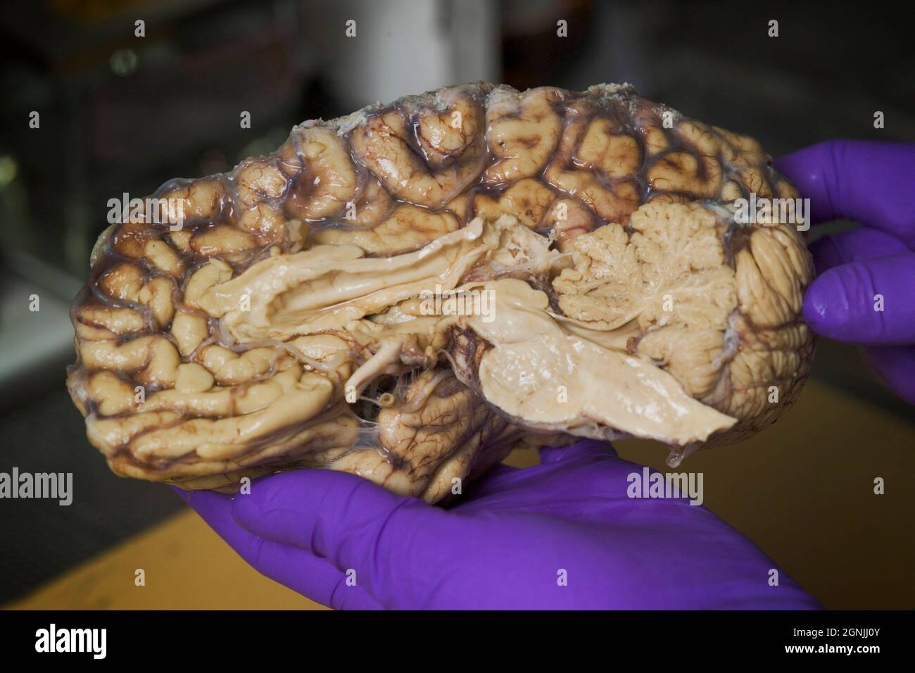 El técnico sostiene el hemisferio del cerebro humano, que ha sido tratado con formol para su conservación, antes de almacenarlo en banco de cerebro para investigación médica Foto de stock