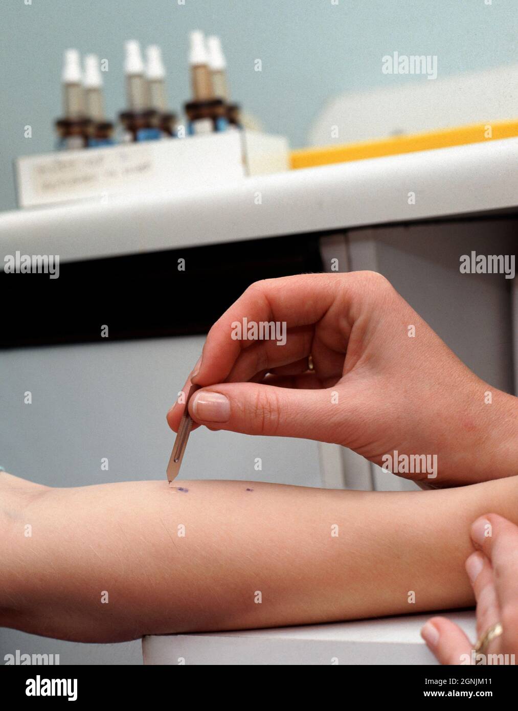 El alergista aplica cantidades diminutas de posibles extractos de alérgenos a la piel del antebrazo de un hombre joven. Foto de stock