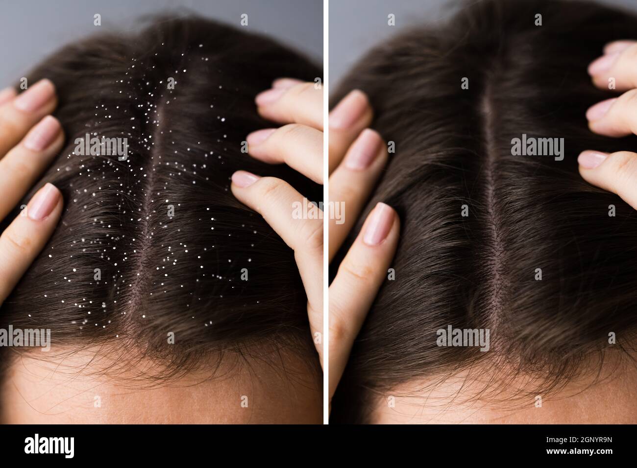 Problemas de cabeza con picazón en el cuero cabelludo y la Dandruff antes y  después Fotografía de stock - Alamy