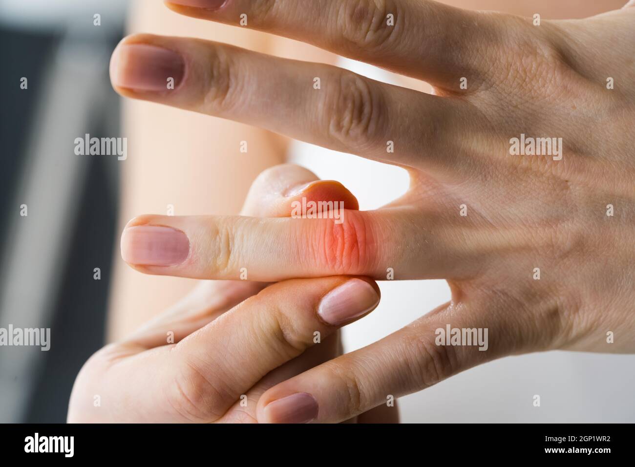 Dedo articulación de la mano dolor y esguince Fotografía de stock - Alamy