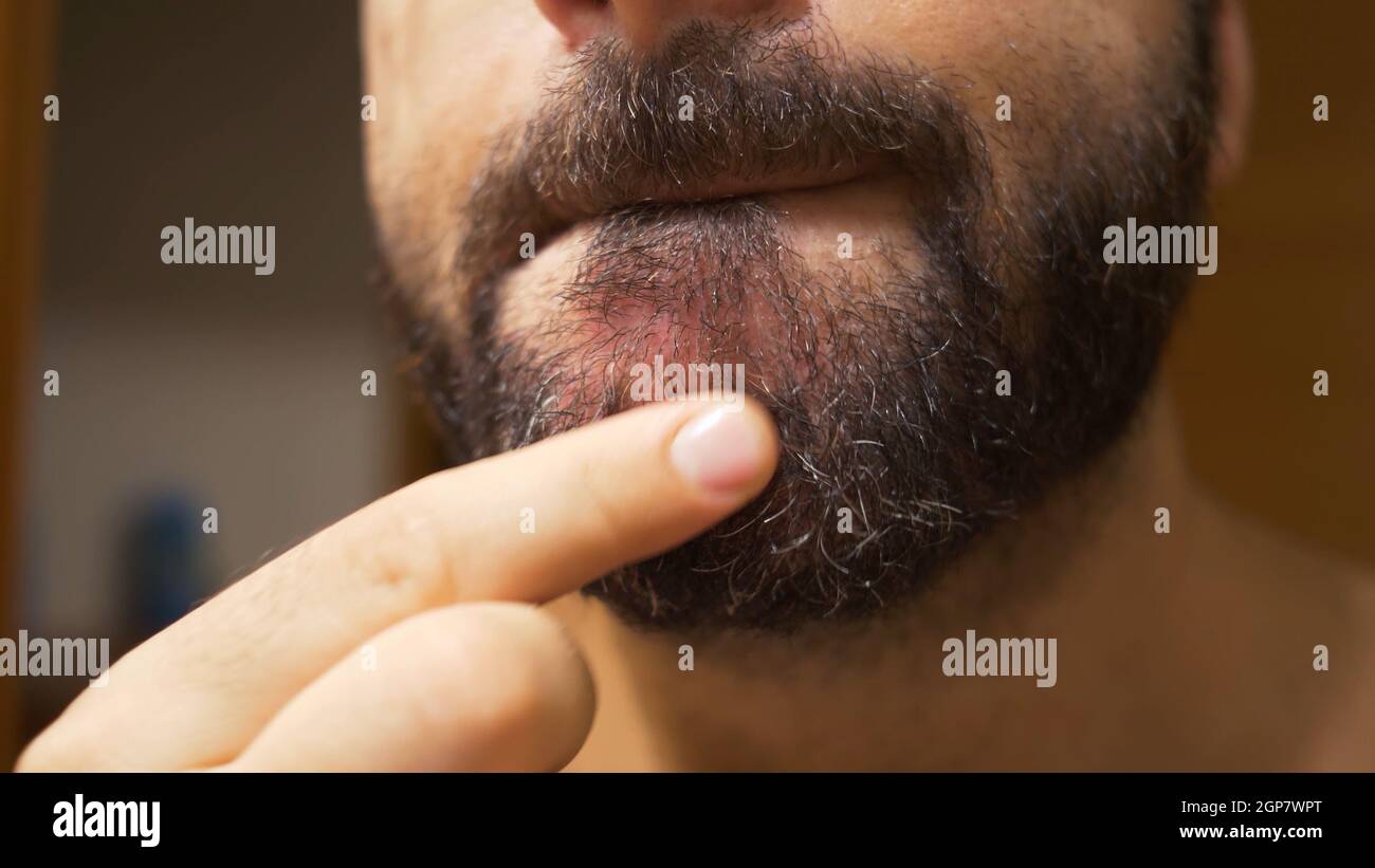 gatito Paine Gillic Político Detalle de la barbilla del hombre con dermatitis seborreica en la zona de la  barba. La piel seca se pela y causa picazón y caspa Fotografía de stock -  Alamy
