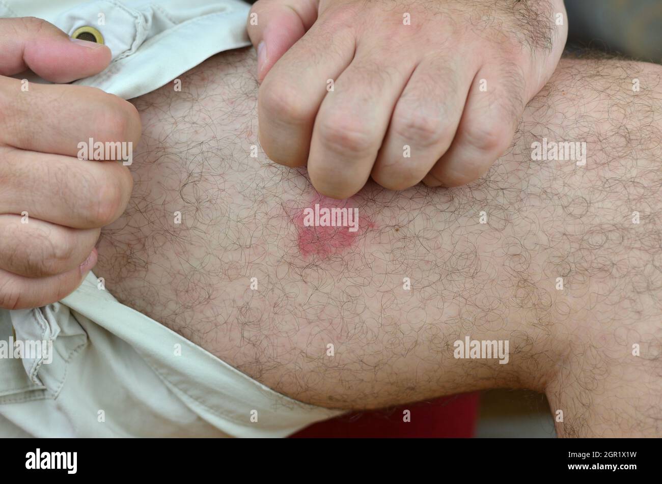 Rascarse Piel roja irritada en la pierna en el sitio de las picaduras de  insectos Fotografía de stock - Alamy
