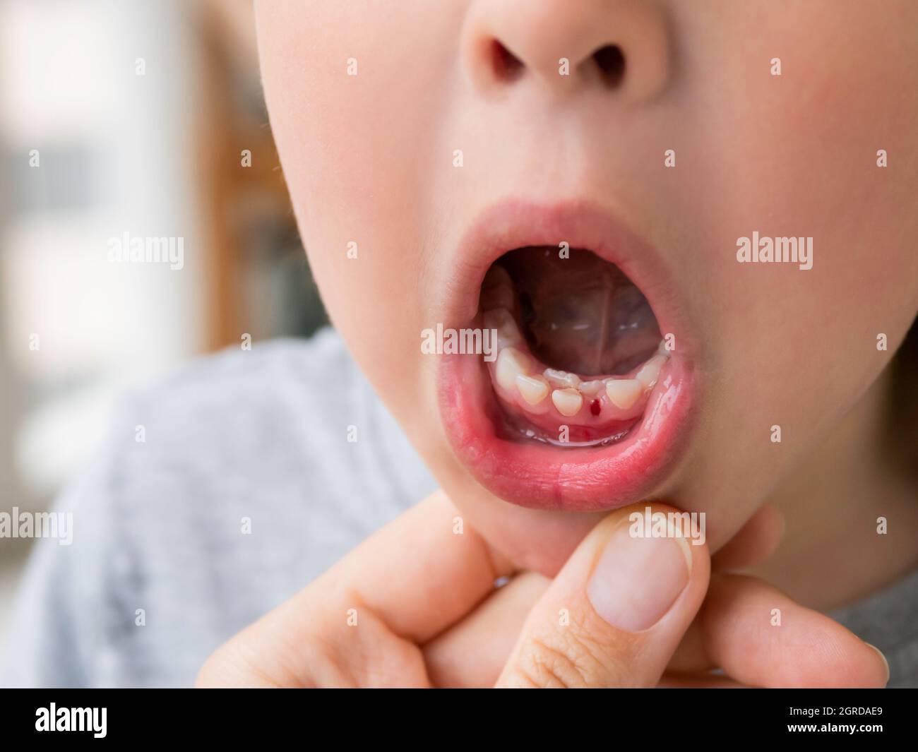 El niño pequeño muestra doble fila de dientes.molares creció antes de que  los dientes de leche cayeran fuera.El incisor inferior se cayó Fotografía  de stock - Alamy