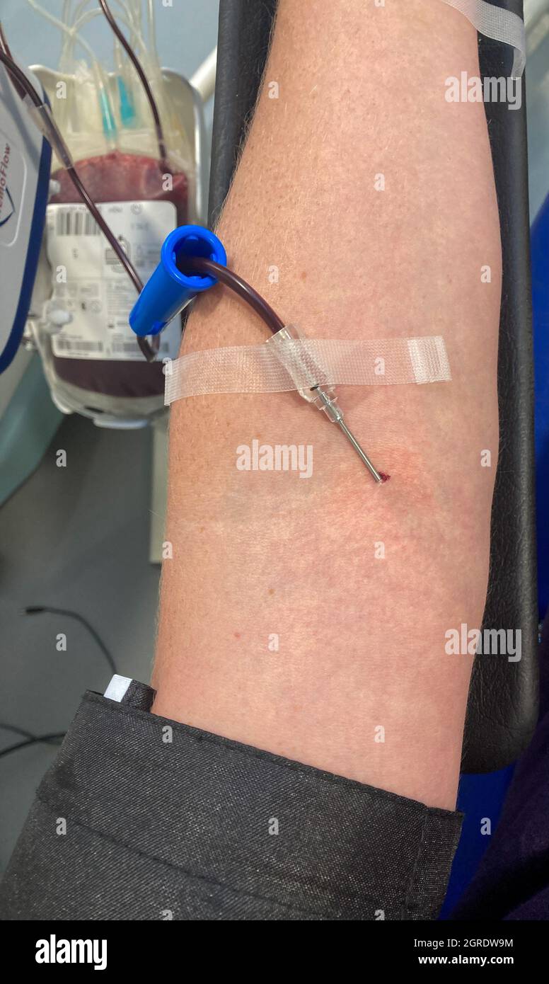 Un donante de sangre da sangre en un centro de donación de sangre del NHS  con una aguja en el brazo y sangre visible en un tubo de plástico. Centro  de Donantes