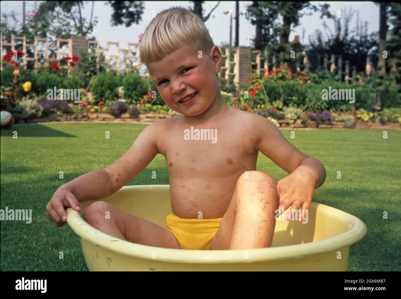 Archivo 1969 VISTA DE VERANO DEL JOVO CON TORSO INFECTADO CON CHILDS Varicela Una enfermedad altamente contagiosa que se muestra como un erupción del virus de la piel recuperándose en 1960s jardín jugando en una tina de agua también presenta cortes de hierba pegándose a él Cuerpo después de jugar en un césped recientemente cortado 60s imagen de archivo Inglaterra Reino Unido Foto de stock