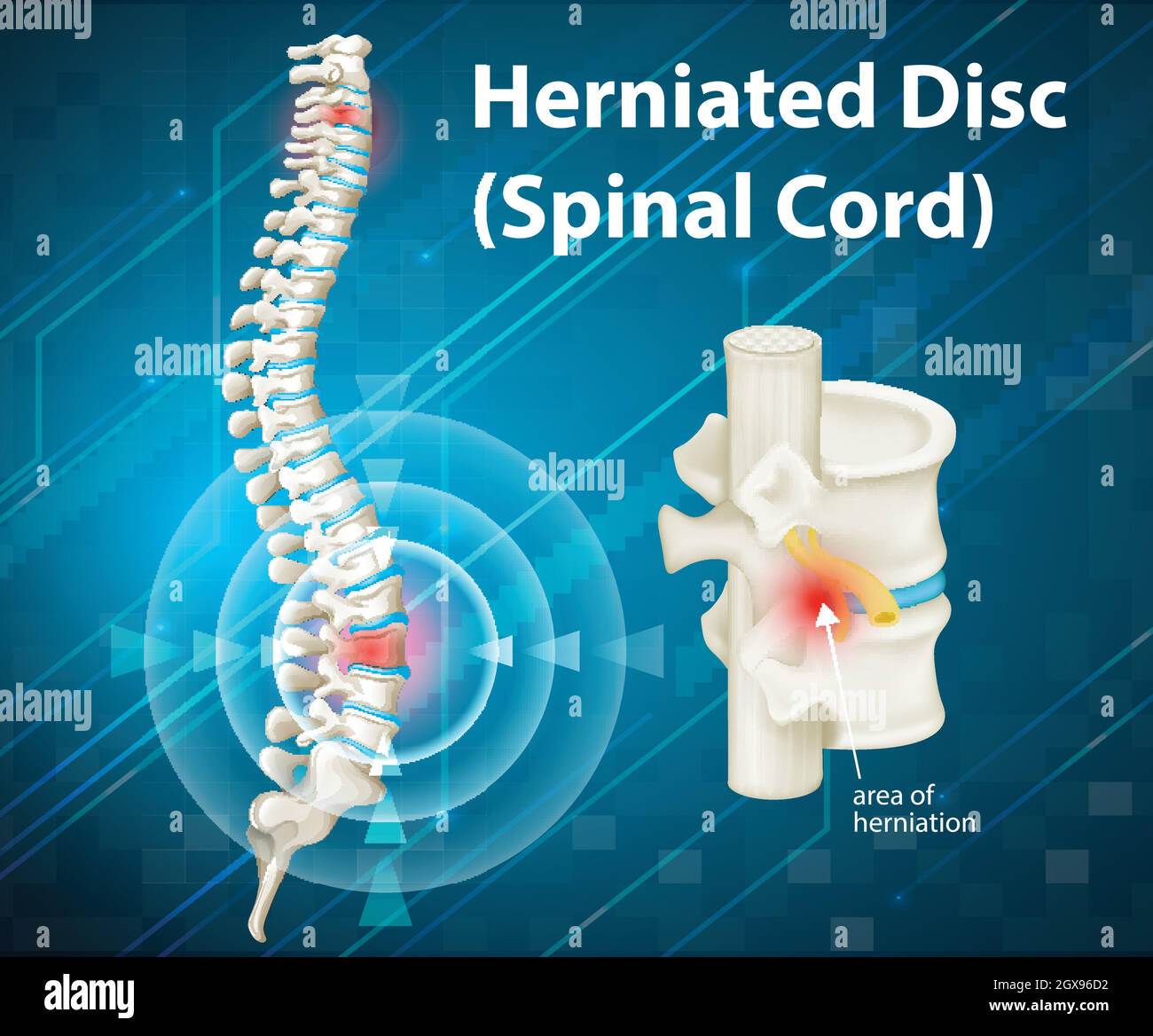 Diagrama Que Muestra El Disco Herniado Imagen Vector De Stock Alamy