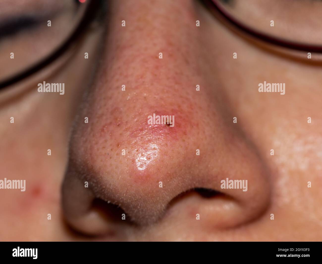 Detalle de un pequeño pustule inflamado en la piel de una persona caucásica Foto de stock