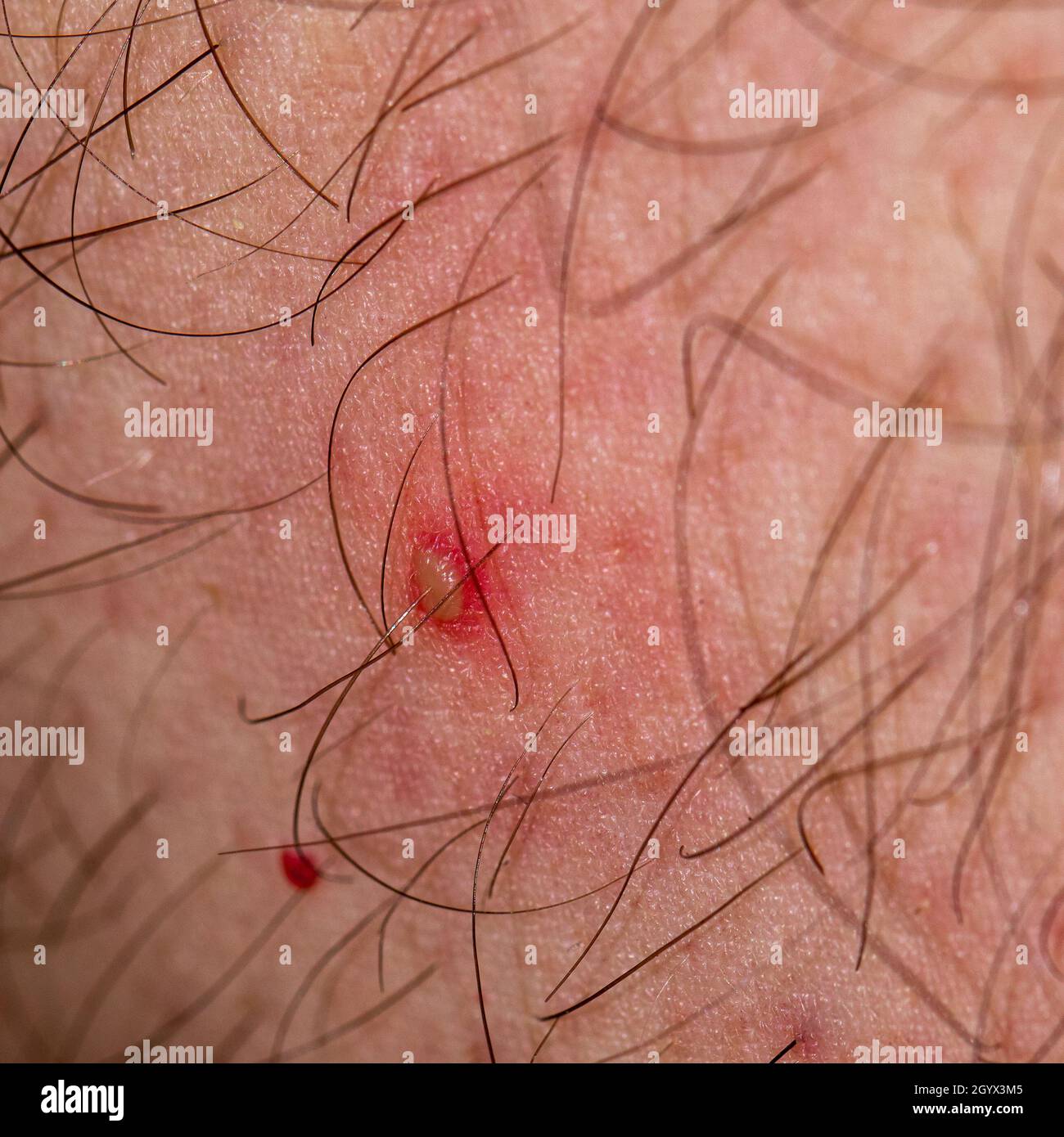 Detalle de un pequeño pustule inflamado en la piel de una persona caucásica Foto de stock