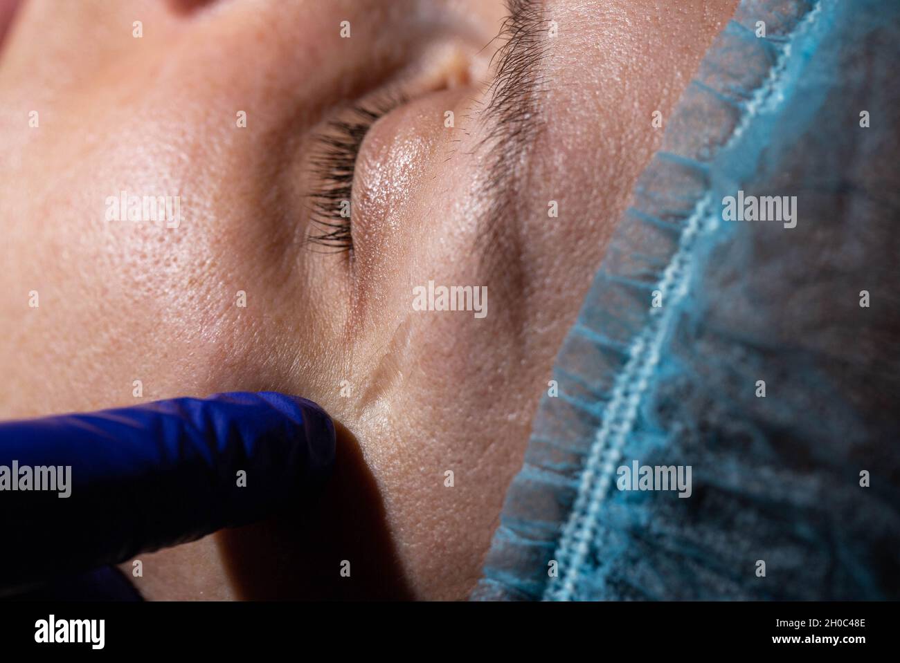 Una cicatriz profunda en la cara de la chica cerca del ojo. Concepto para  la eliminación de cicatrices en cosmetología mediante el repavimentación  láser Fotografía de stock - Alamy