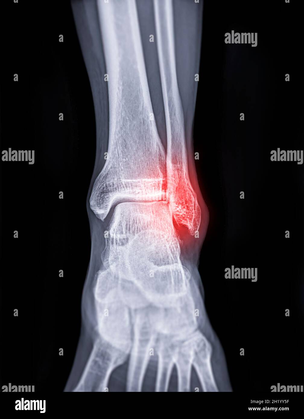 Imagen de radiografía de la articulación del tobillo que muestra una fractura de la articulación