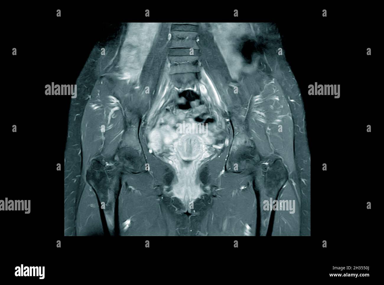 Resonancia Magnética Imágenes Pélvicas de una Mujer Saludable Encontrar anormalidades como masas. Concepto de salud médica. Foto de stock