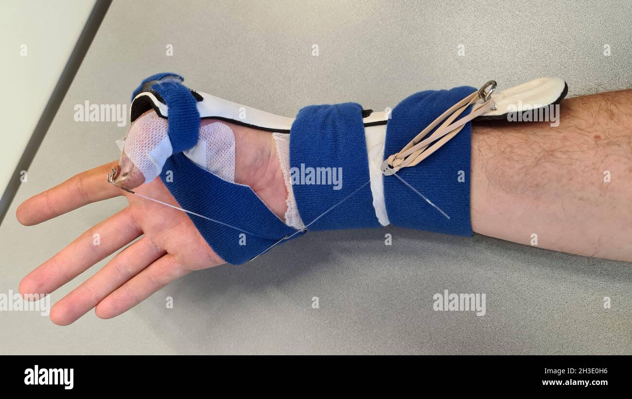 mano con férula después de cortar el tendón flexor del pulgar Foto de stock
