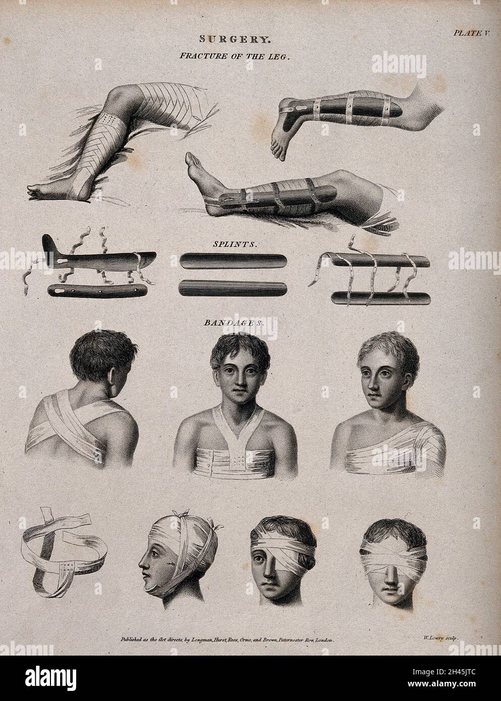 Cirugía Fractura de piernas, férulas y vendajes. Grabado por W. Lowry