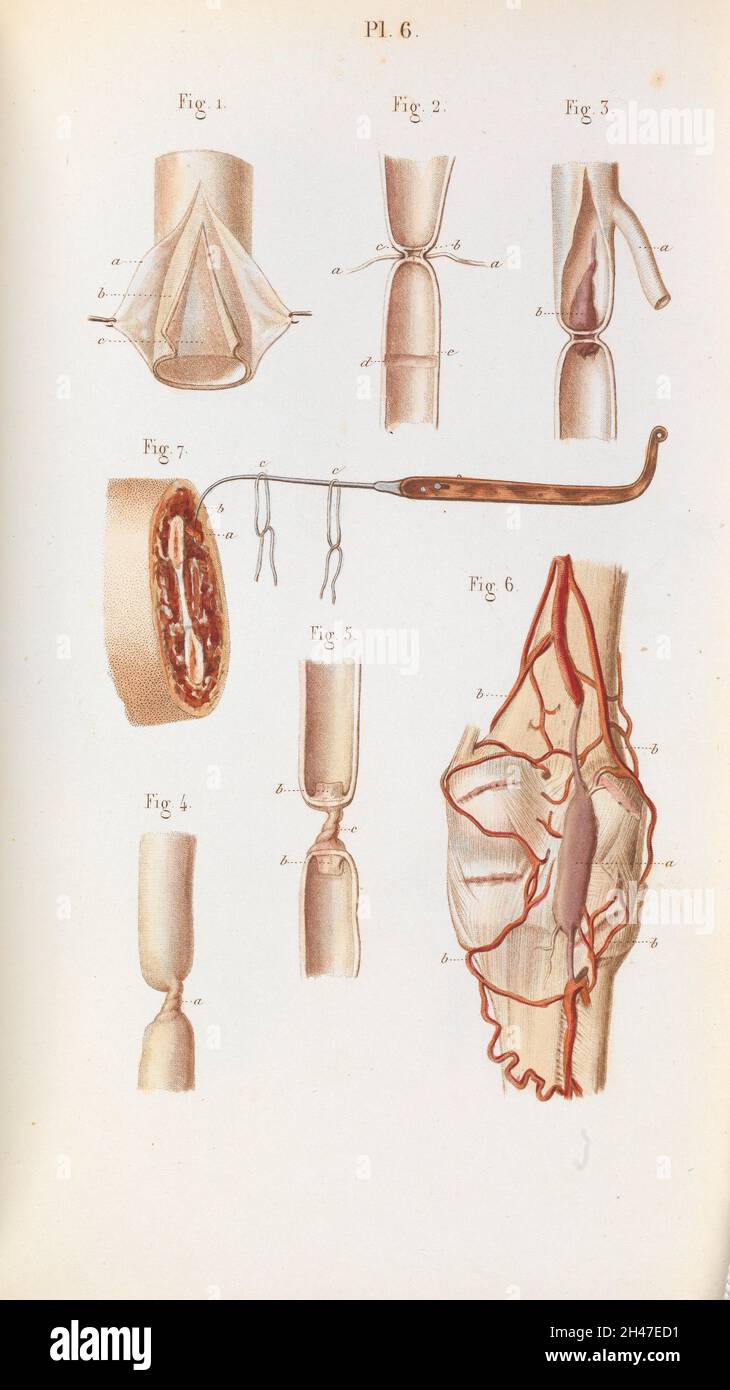 Arterias de las piernas fotografías e imágenes de alta resolución Página 2 Alamy