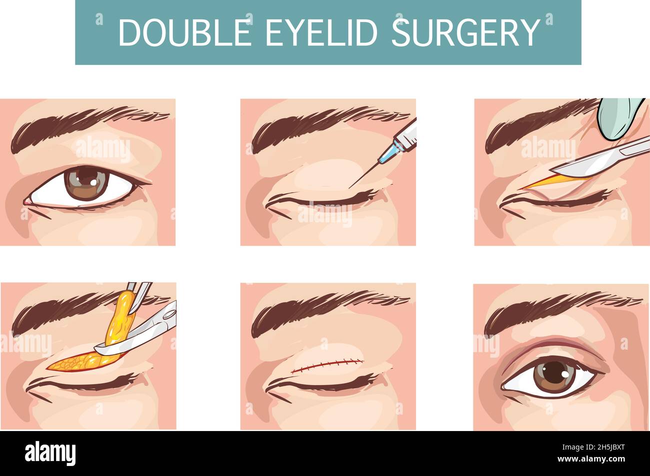 Conjunto ilustrado vectorial con cirugía de párpado doble Imagen Vector