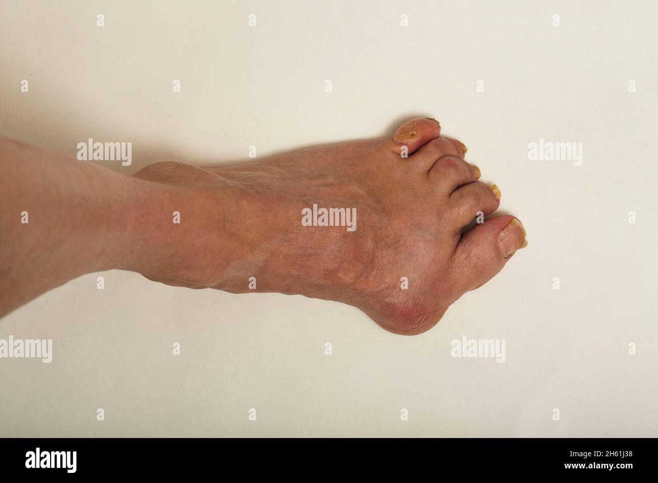 Un pie mal deformado con juanetes Foto de stock
