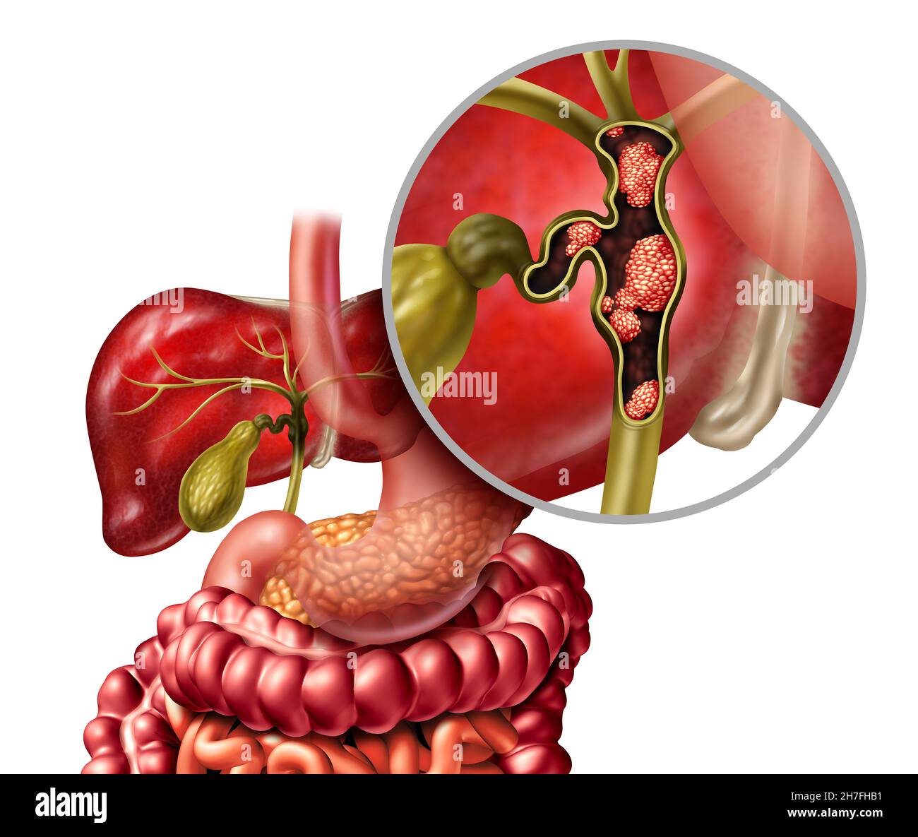 Cáncer de las vías biliares o colangiocarcinoma con vesícula biliar e hígado como enfermedad del sistema digestivo que representa una atención médica. Foto de stock