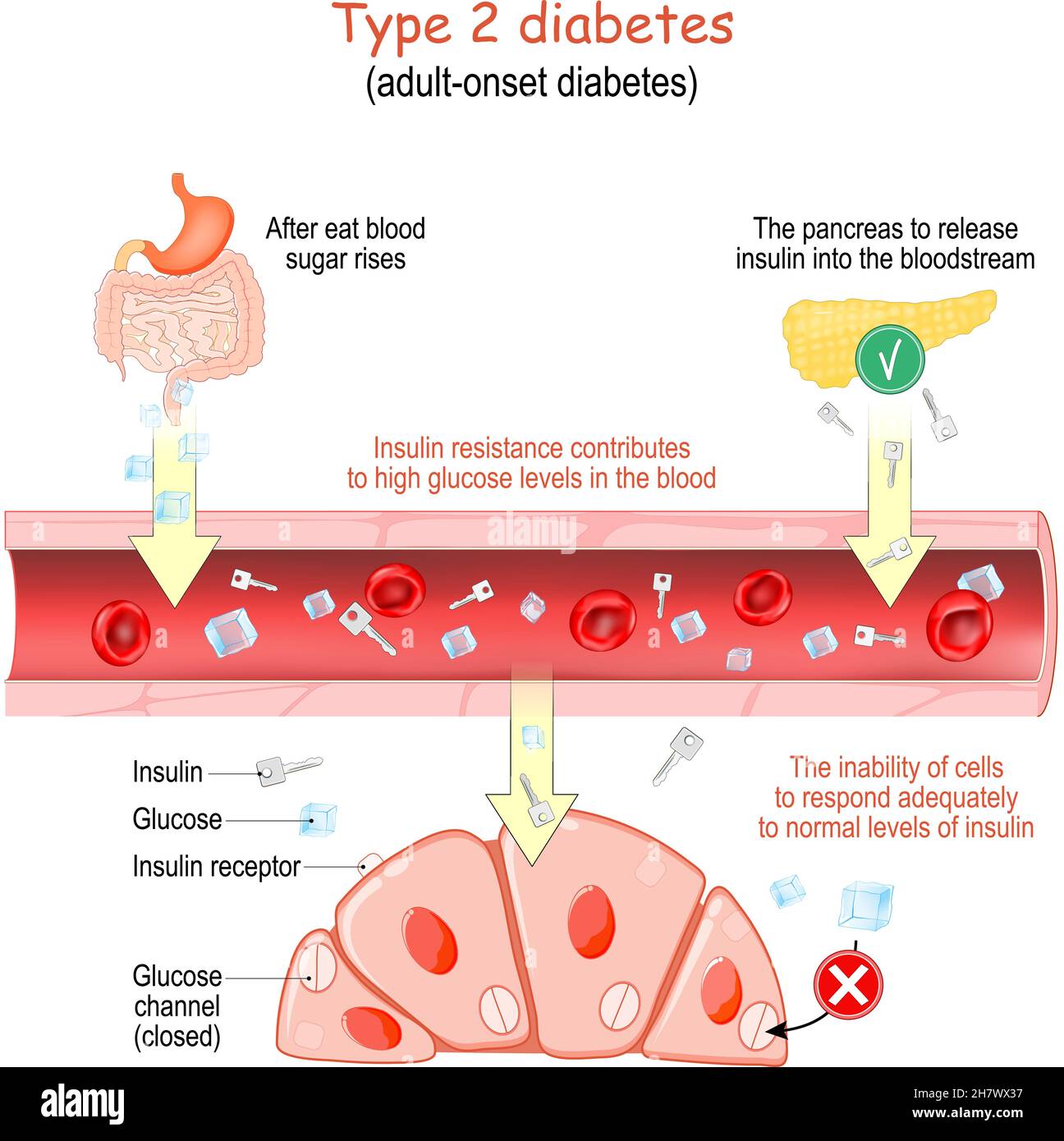 Diabetes tipo 2. Diabetes de inicio en adultos. La resistencia a la insulina  contribuye a niveles altos de glucosa en la sangre. La incapacidad de las  células para responder adecuadamente Imagen Vector