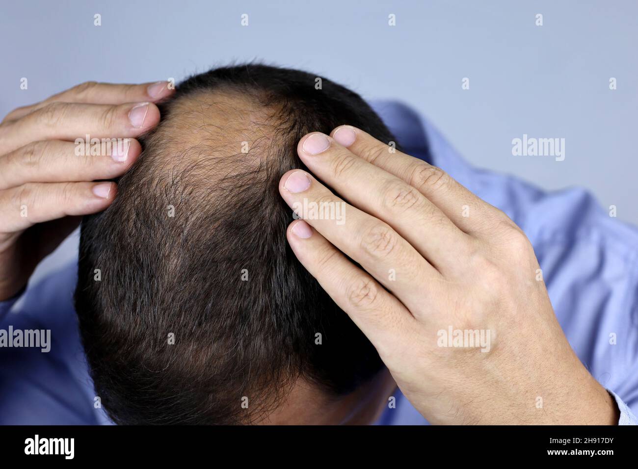Hombre preocupado por la pérdida del cabello. Calvicie, manos masculinas en una calva Foto de stock