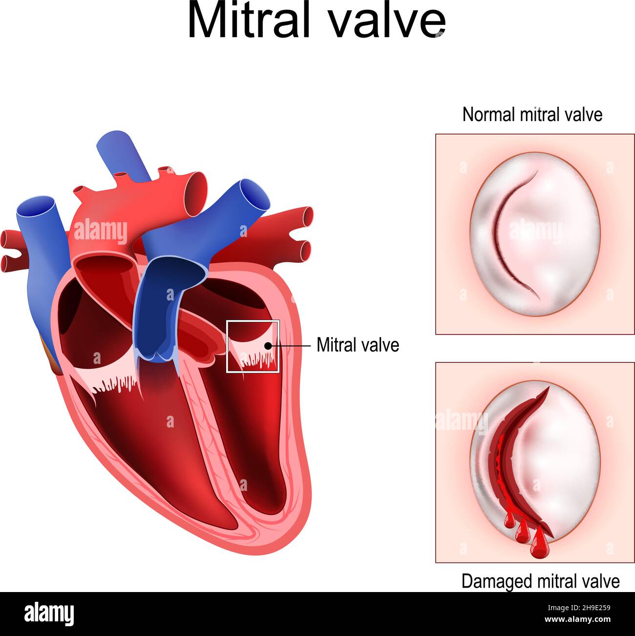 Válvula del corazón fotografías e imágenes de alta resolución - Alamy