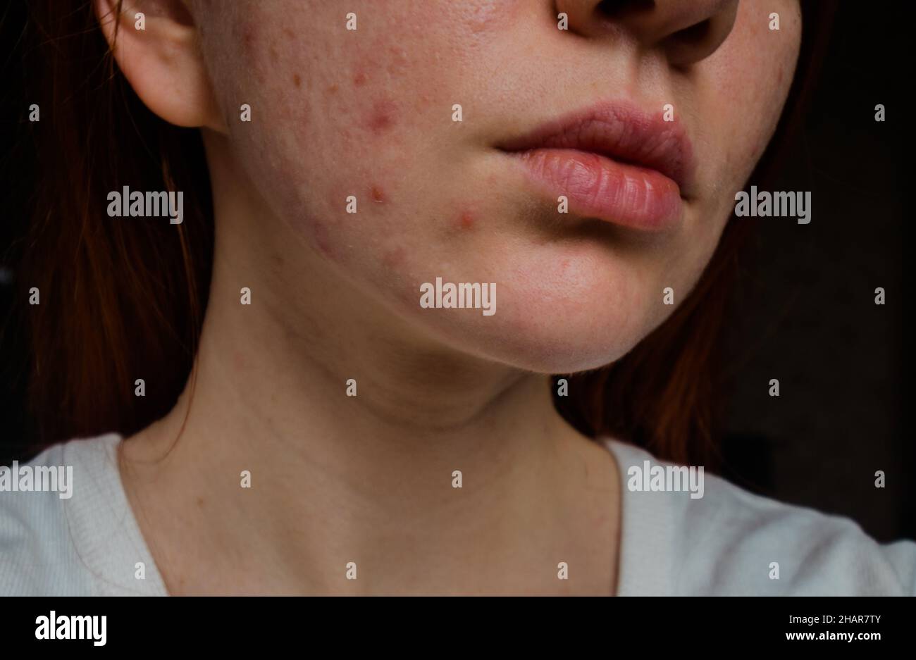 Problema de piel en una niña. Primer plano de espinillas en la cara. Foto de stock