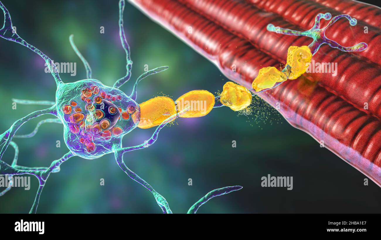 Neuronas en la enfermedad de Tay-Sachs. Ilustración que muestra neuronas hinchadas con inclusiones lamelares membranosas debido a la acumulación de gangliósidos en lisosomas, degradación de mielina. La enfermedad de Tay-Sachs es un trastorno que destruye progresivamente las neuronas cerebrales, es causada por una mutación en el gen HEXA del cromosoma 15 que conduce a la deficiencia de hexosaminidasa A. Tay-sachs se observa más comúnmente en los bebés, manifestándose en debilidad muscular y disminución de la función motora, pérdida de visión y audición, y discapacidad intelectual. Foto de stock
