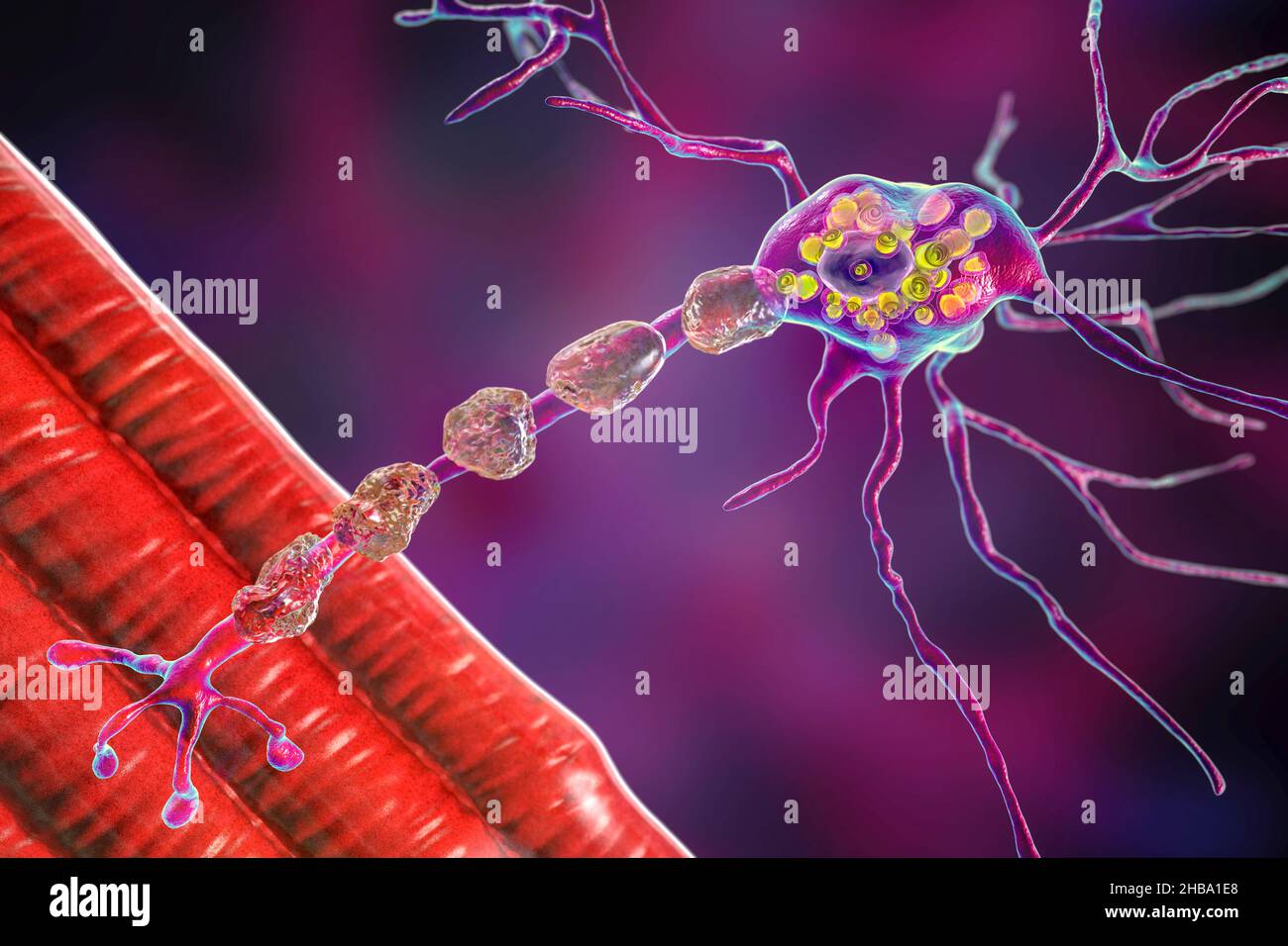 Neuronas en la enfermedad de Tay-Sachs. Ilustración que muestra neuronas hinchadas con inclusiones lamelares membranosas debido a la acumulación de gangliósidos en lisosomas, degradación de mielina. La enfermedad de Tay-Sachs es un trastorno que destruye progresivamente las neuronas cerebrales, es causada por una mutación en el gen HEXA del cromosoma 15 que conduce a la deficiencia de hexosaminidasa A. Tay-sachs se observa más comúnmente en los bebés, manifestándose en debilidad muscular y disminución de la función motora, pérdida de visión y audición, y discapacidad intelectual. Foto de stock