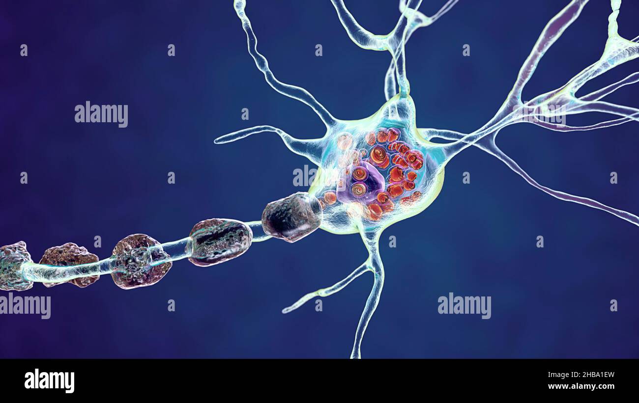 Neuronas en la enfermedad de Tay-Sachs. Ilustración que muestra neuronas hinchadas con inclusiones lamelares membranosas debido a la acumulación de gangliósidos en lisosomas. La enfermedad de Tay-Sachs es un trastorno que destruye progresivamente las neuronas cerebrales, es causada por una mutación en el gen HEXA del cromosoma 15 que conduce a la deficiencia de hexosaminidasa A. Tay-sachs se observa más comúnmente en los bebés, manifestándose en debilidad muscular y disminución de la función motora, pérdida de visión y audición, y discapacidad intelectual. Foto de stock