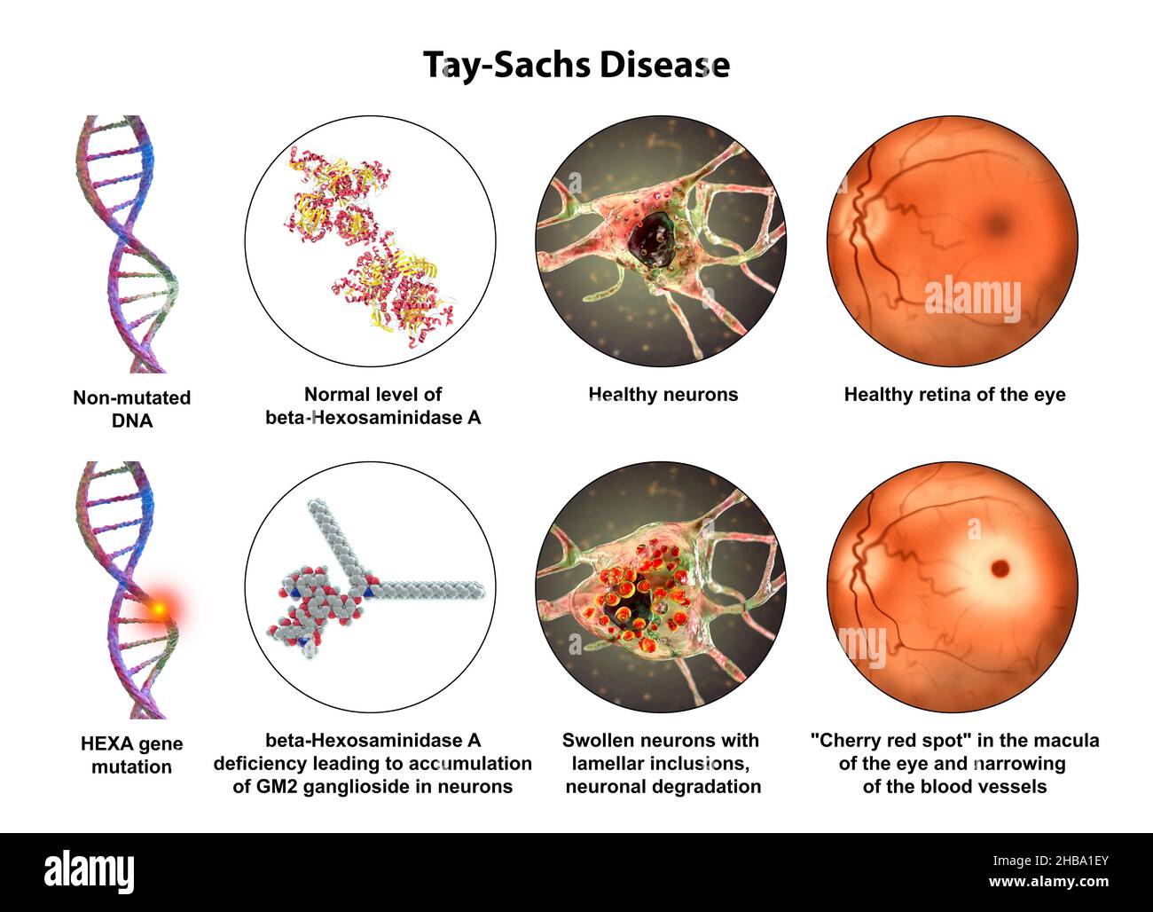 Ilustración de la enfermedad de Tay-Sachs, un trastorno genético que destruye progresivamente las neuronas cerebrales. Es causada por una mutación en el gen HEXA del cromo Foto de stock