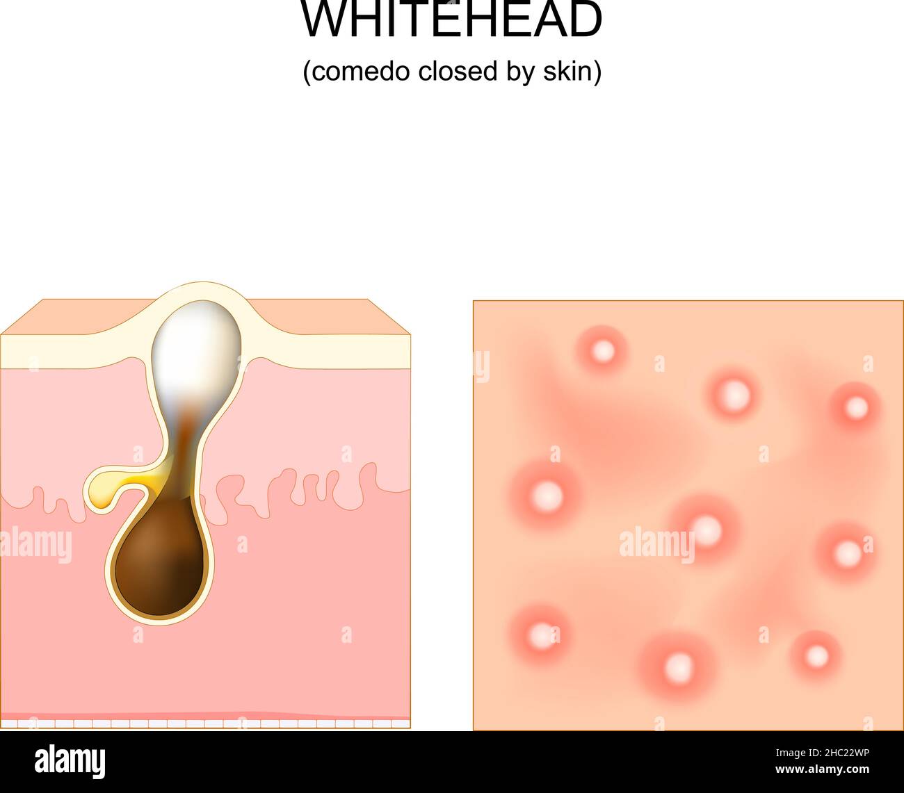 Acné. whitehead. Poros y comedo obstruidos. Sección transversal de una piel humana con folículo piloso. Vista superior de la piel con espinillas. Vector Ilustración del Vector