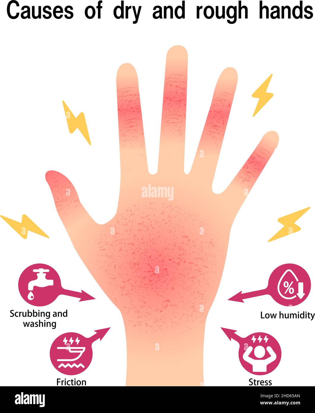 Causas de la ilustración vectorial de las manos secas y ásperas ( manos  agrietadas Imagen Vector de stock - Alamy