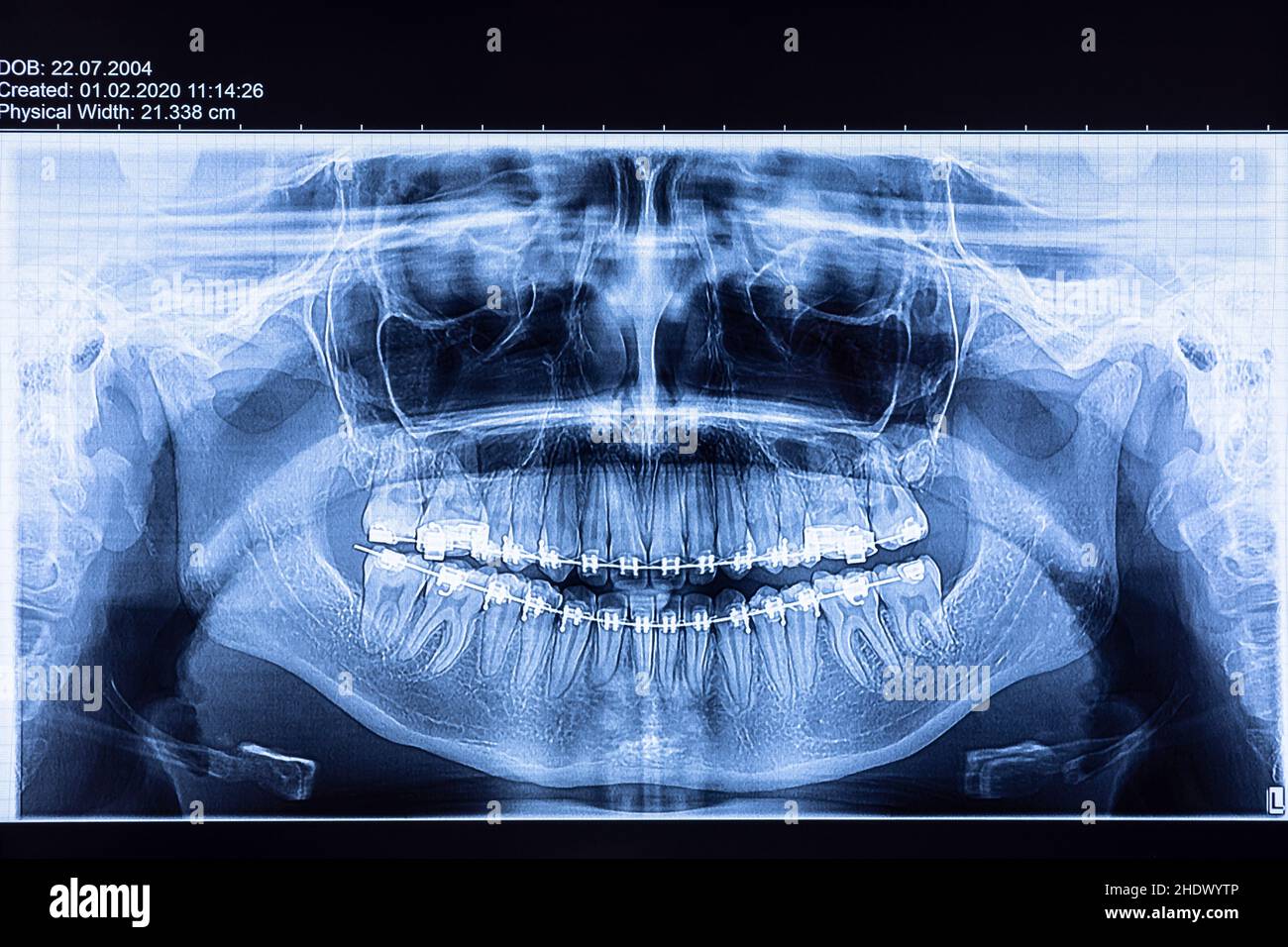 imágenes de rayos x, médicas, radiológicas, radiografías, rayos x, rayos x, medicamentos Foto de stock