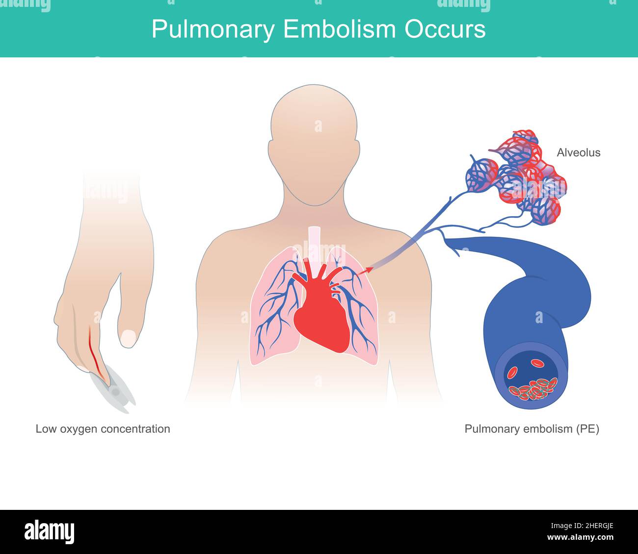 Se presenta embolismo pulmonar. Se presenta una condición anormal de bajo nivel de oxígeno en la sangre como causa de embolia pulmonar. Ilustración del Vector