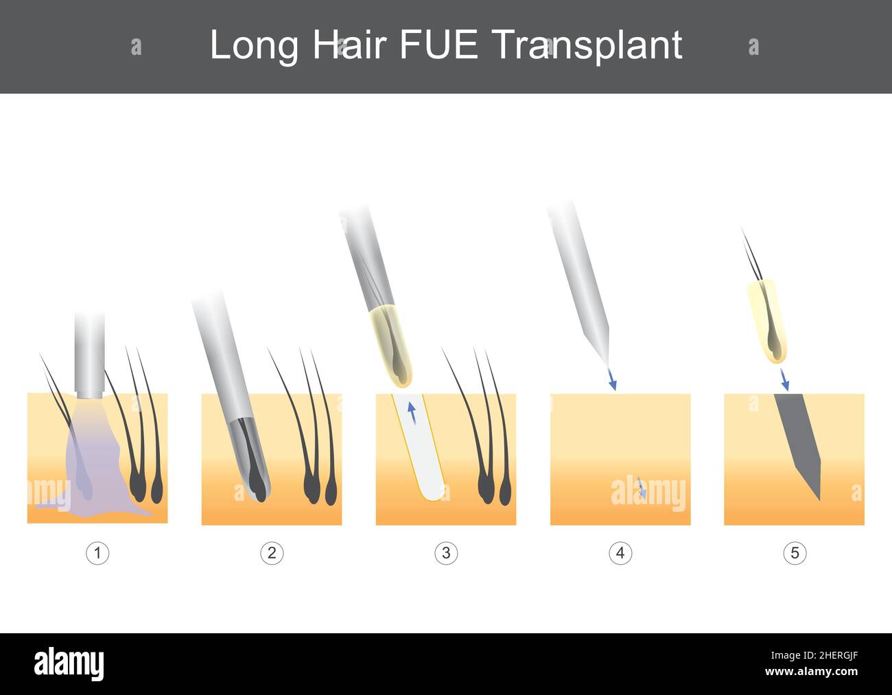 Trasplante de PELO largo. Ilustración médica que muestra los pasos técnicos del trasplante de cabello. Ilustración del Vector