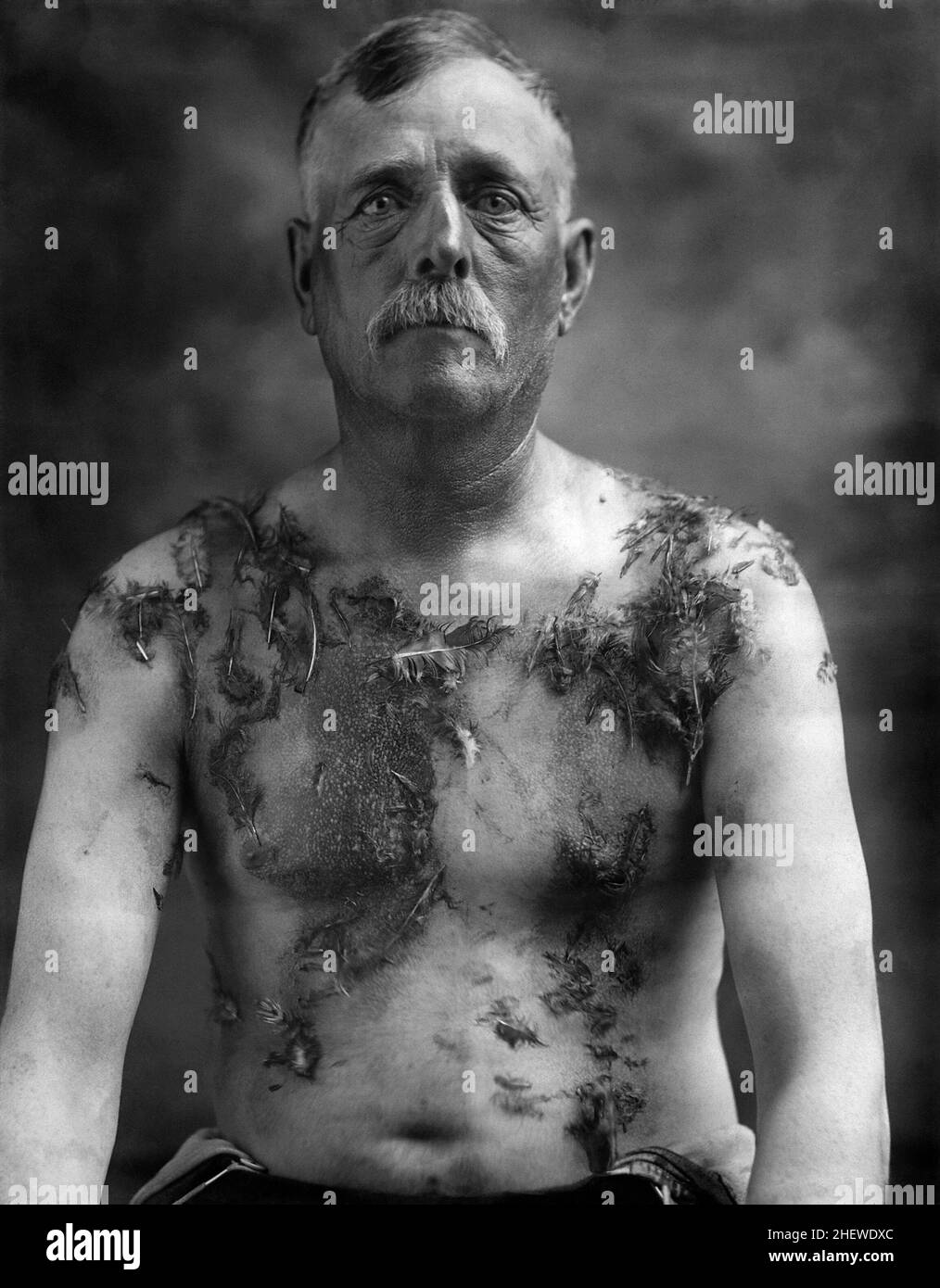 Un granjero alemán americano John Meintz que fue golpeado y empañado y emplumado en Dakota del Sur en 1918 Foto de stock